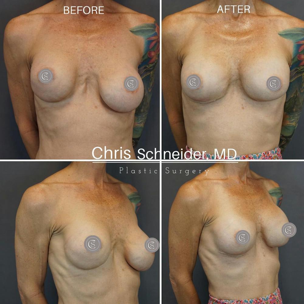 Breast Revision Before & After Gallery - Patient 149284190 - Image 1