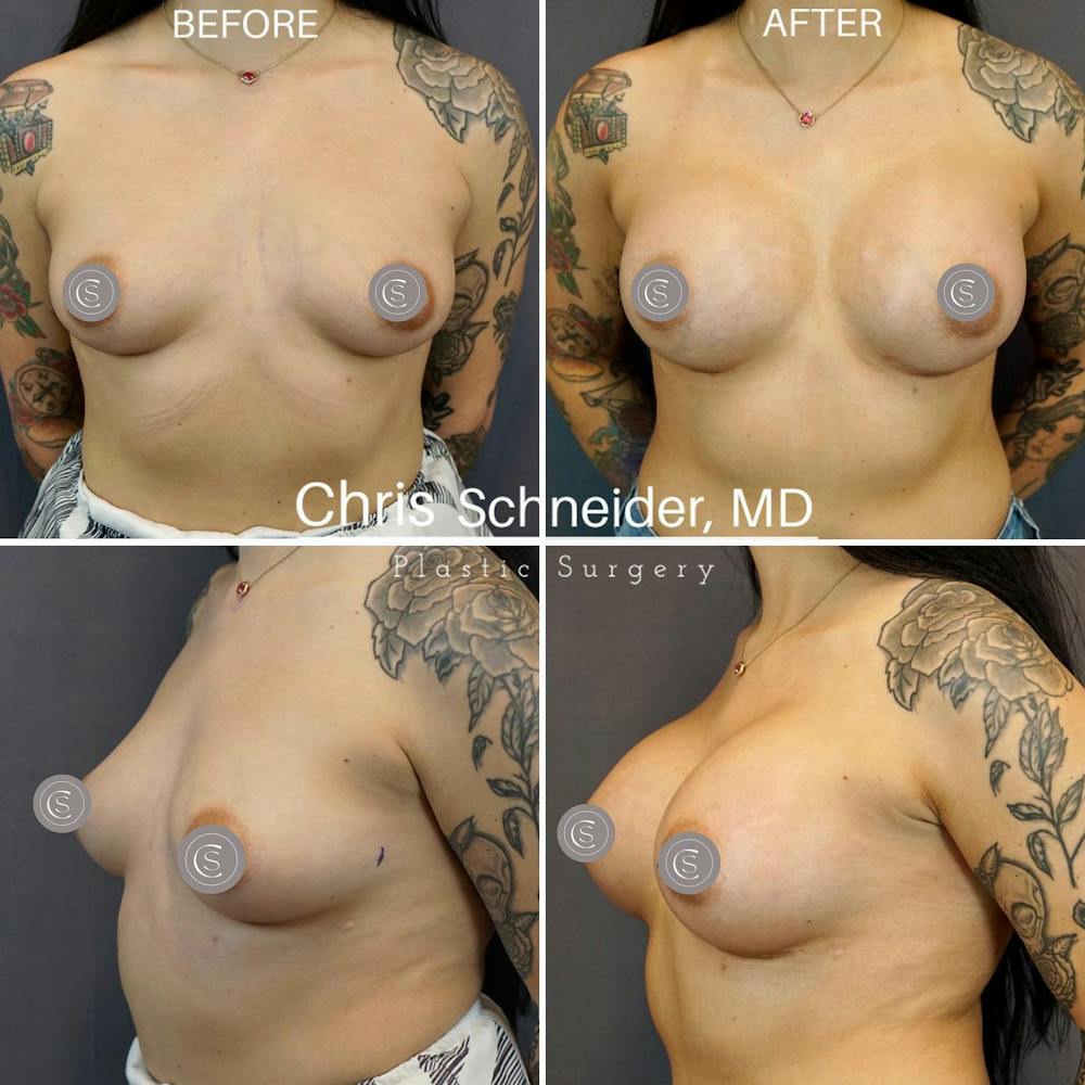 Breast Augmentation Before & After Gallery - Patient 149284193 - Image 1