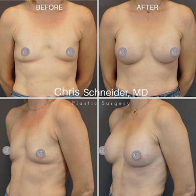 Breast Augmentation Before & After Gallery - Patient 149284194 - Image 1