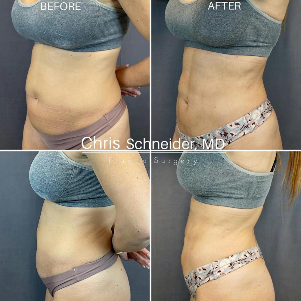 Liposculpture and Liposuction Before and After