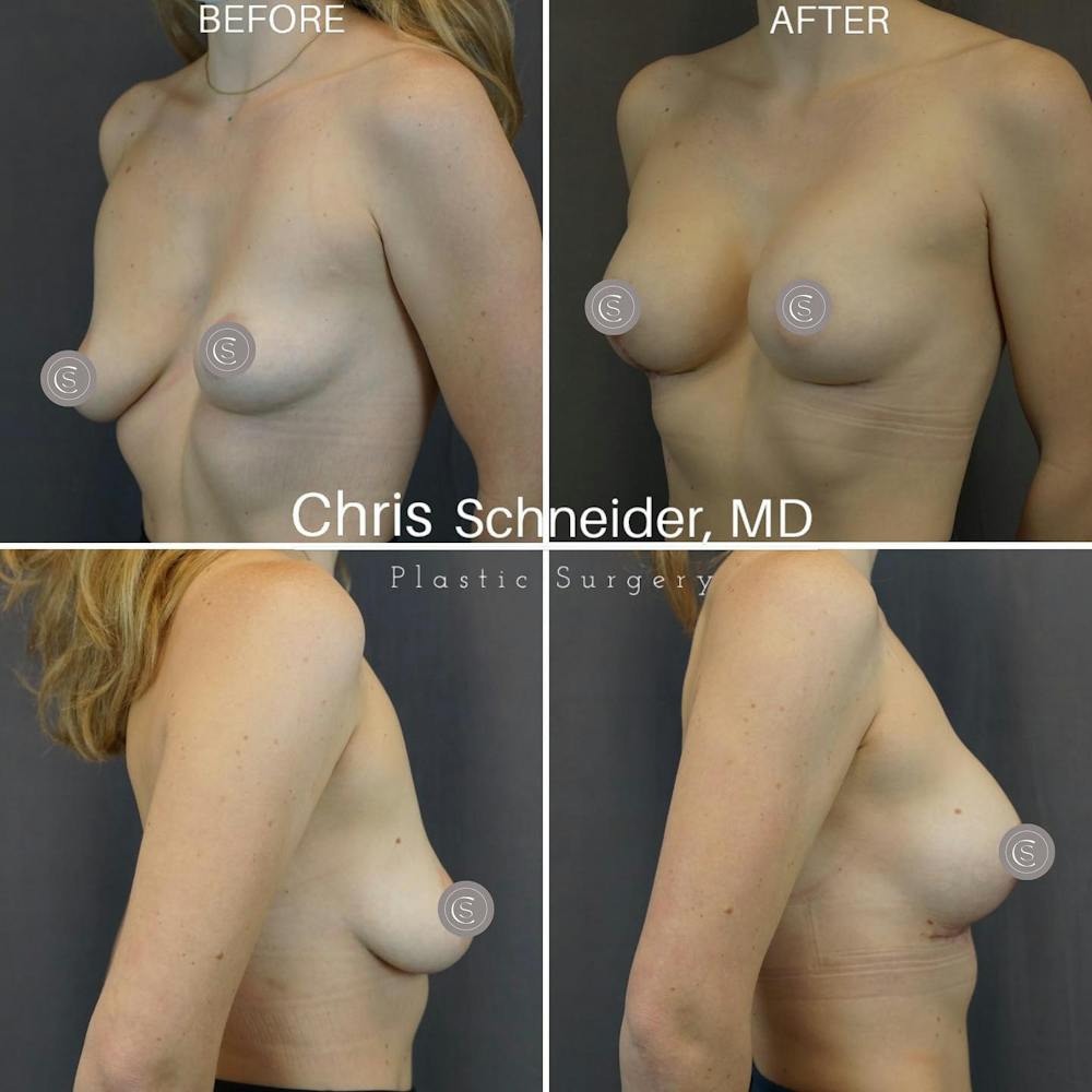 Breast Augmentation Before & After Gallery - Patient 149284239 - Image 1