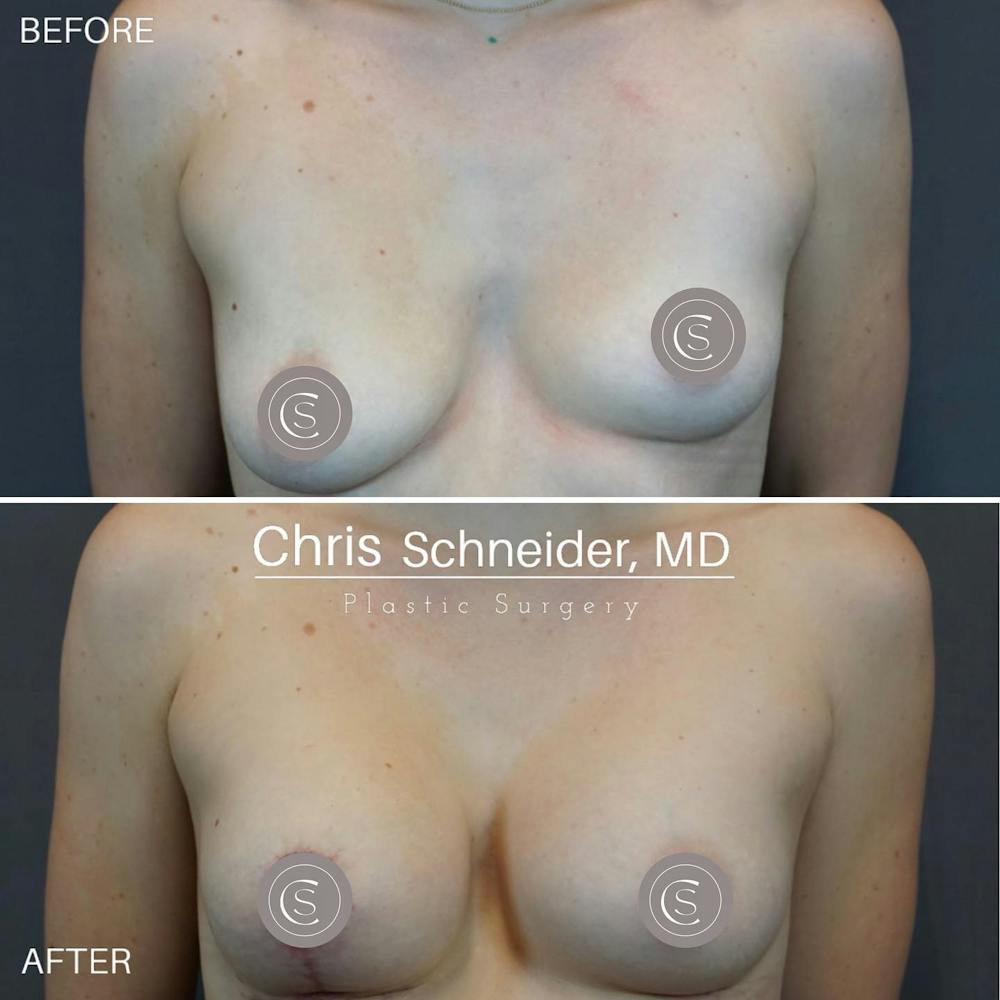 Breast Augmentation Before & After Gallery - Patient 149284239 - Image 2
