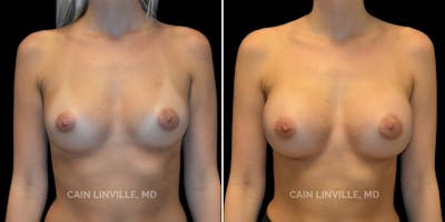 Breast Augmentation Before & After Gallery - Patient 8522753 - Image 1