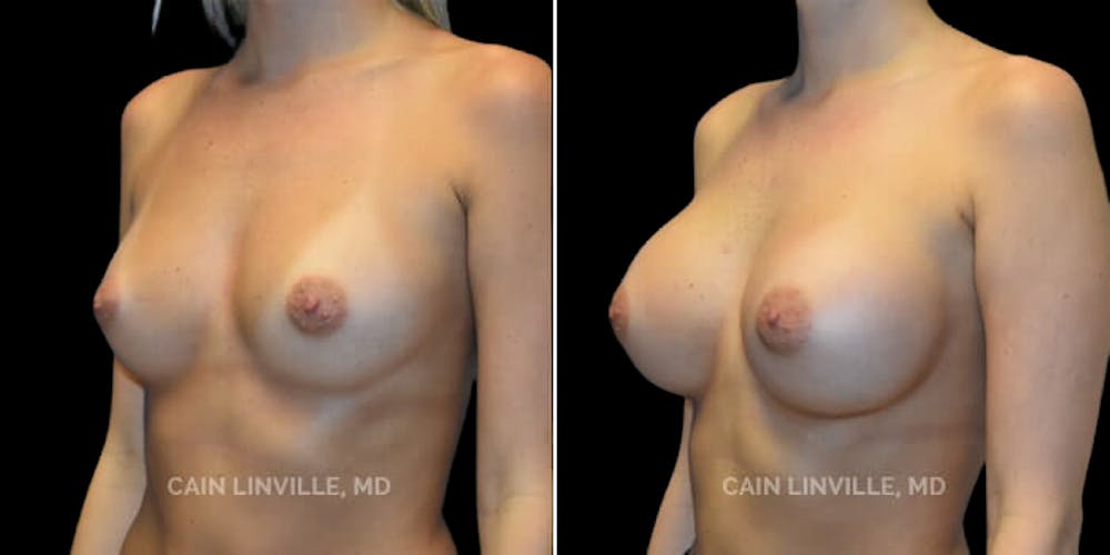 Breast Augmentation Before & After Gallery - Patient 8522753 - Image 2