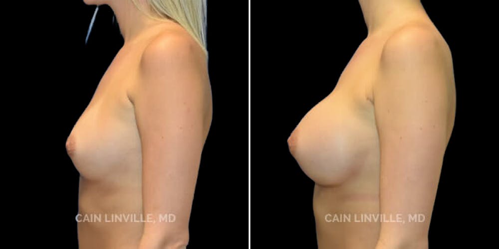 Breast Augmentation Before & After Gallery - Patient 8522753 - Image 3