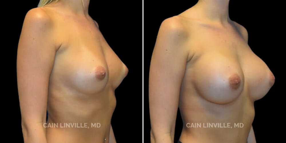 Breast Augmentation Before & After Gallery - Patient 8522753 - Image 4