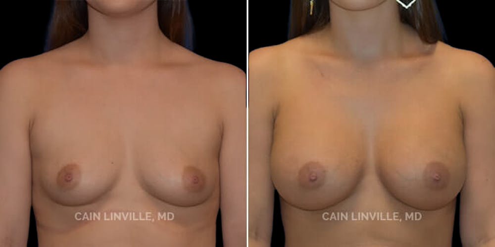 Breast Augmentation Before & After Gallery - Patient 8522766 - Image 1