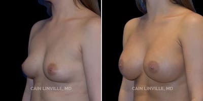 Breast Augmentation Before & After Gallery - Patient 8522766 - Image 2