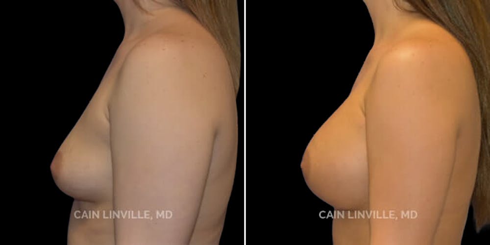 Breast Augmentation Before & After Gallery - Patient 8522766 - Image 3