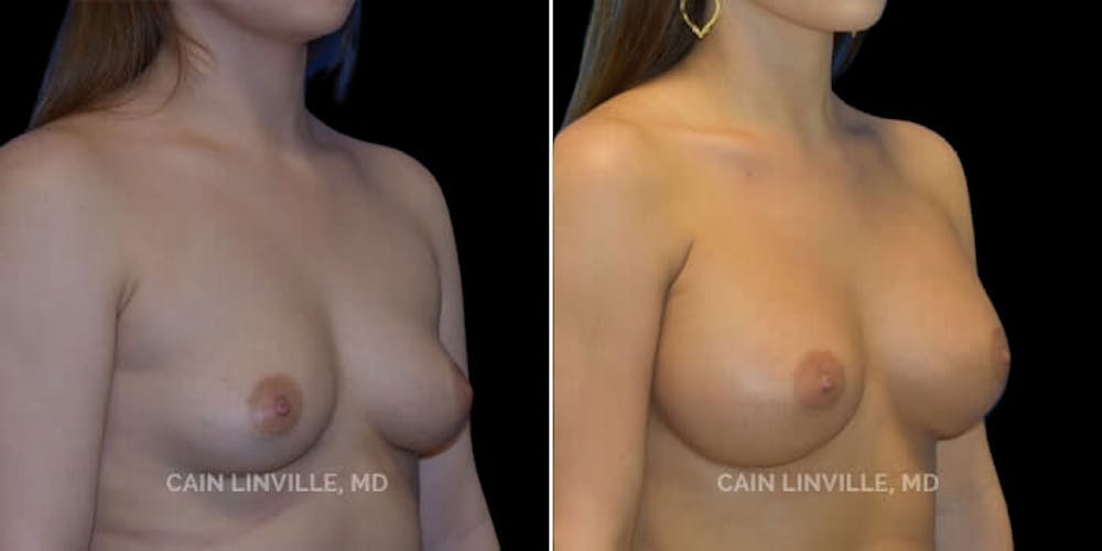 Breast Augmentation Before & After Gallery - Patient 8522766 - Image 4