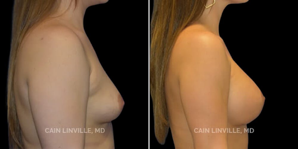 Breast Augmentation Before & After Gallery - Patient 8522766 - Image 5