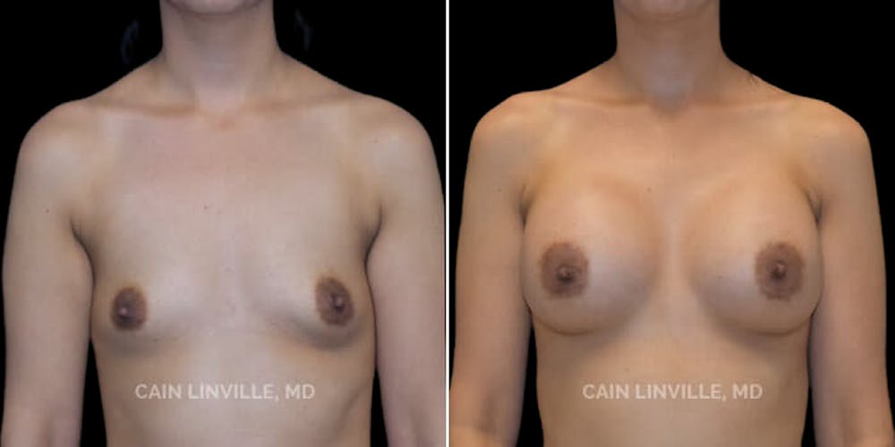 Breast Augmentation Before & After Gallery - Patient 8522784 - Image 1