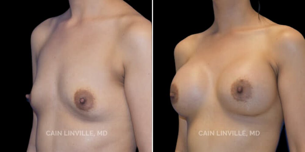 Breast Augmentation Before & After Gallery - Patient 8522784 - Image 2