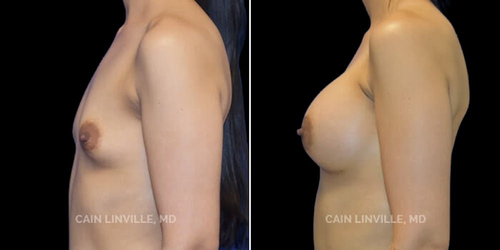 Breast Augmentation Before & After Gallery - Patient 8522784 - Image 3