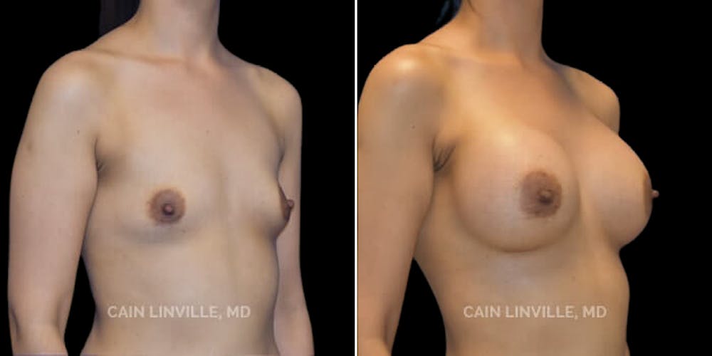 Breast Augmentation Before & After Gallery - Patient 8522784 - Image 4