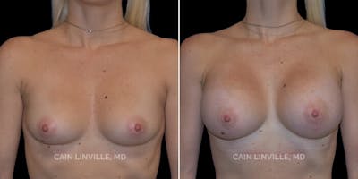 Breast Augmentation Before & After Gallery - Patient 8522802 - Image 1