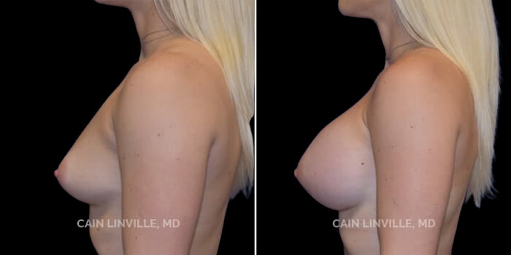 Breast Augmentation Before & After Gallery - Patient 8522802 - Image 3