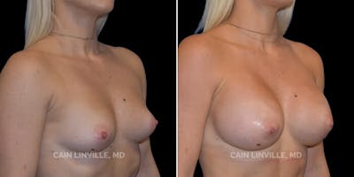 Breast Augmentation Before & After Gallery - Patient 8522802 - Image 4