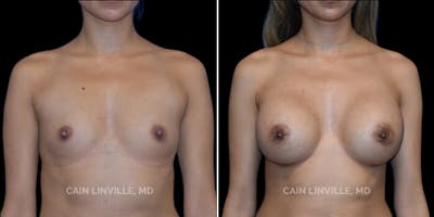 Breast Augmentation Before & After Gallery - Patient 8522816 - Image 1