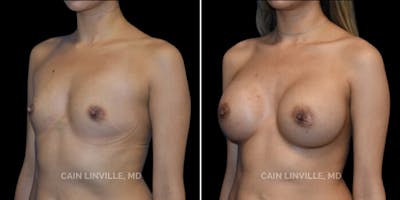 Breast Augmentation Before & After Gallery - Patient 8522816 - Image 2