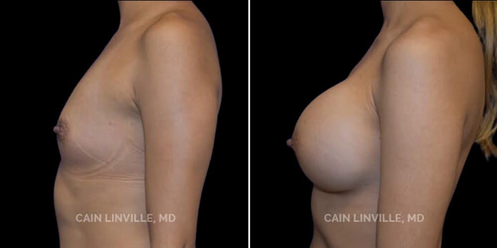 Breast Augmentation Before & After Gallery - Patient 8522816 - Image 3