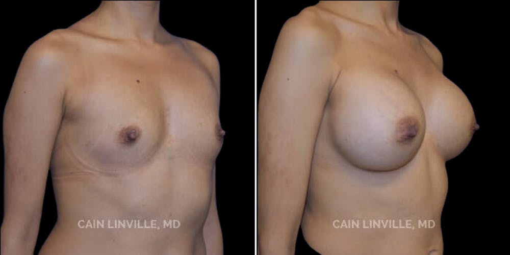Breast Augmentation Before & After Gallery - Patient 8522816 - Image 4