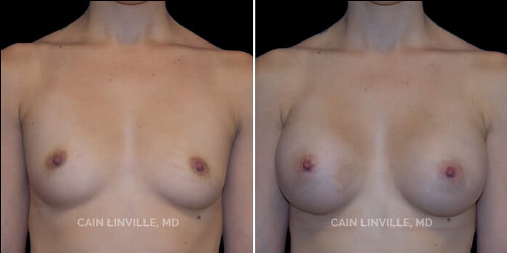 Breast Augmentation Before & After Gallery - Patient 8522833 - Image 1