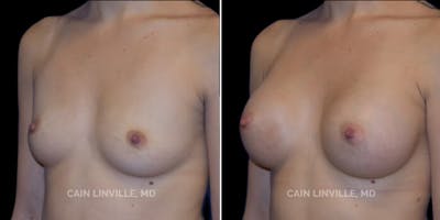 Breast Augmentation Before & After Gallery - Patient 8522833 - Image 2