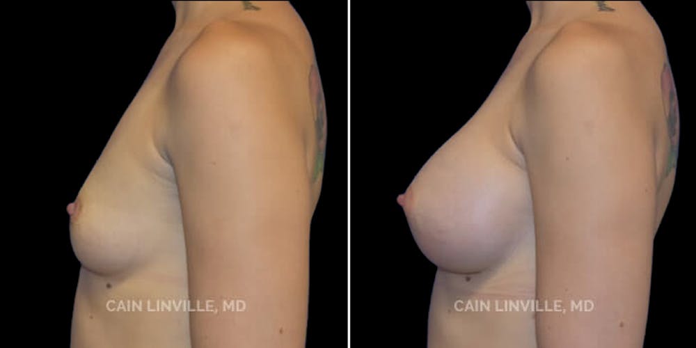 Breast Augmentation Before & After Gallery - Patient 8522833 - Image 3