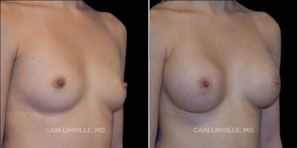 Breast Augmentation Before & After Gallery - Patient 8522833 - Image 4