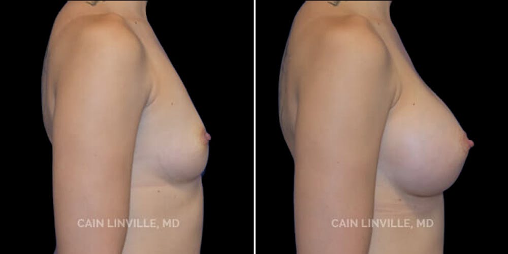 Breast Augmentation Before & After Gallery - Patient 8522833 - Image 5