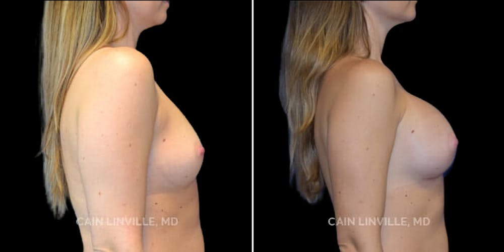 Breast Augmentation Before & After Gallery - Patient 8522845 - Image 2