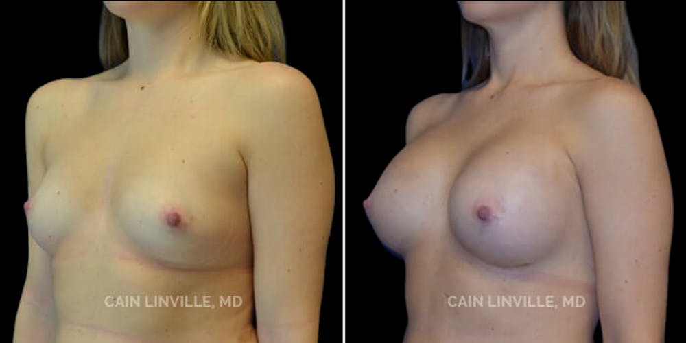 Breast Augmentation Before & After Gallery - Patient 8522845 - Image 3