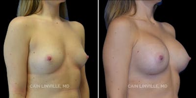 Breast Augmentation Before & After Gallery - Patient 8522845 - Image 4
