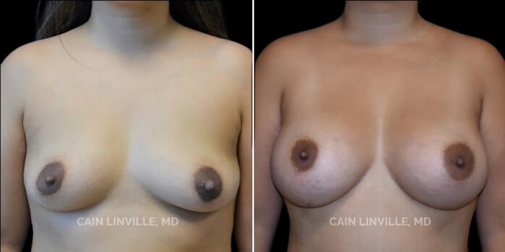 Breast Augmentation Before & After Gallery - Patient 8522864 - Image 1
