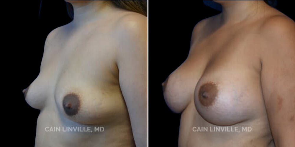 Breast Augmentation Before & After Gallery - Patient 8522864 - Image 2