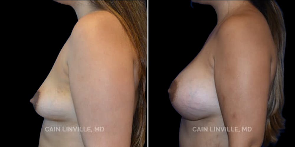 Breast Augmentation Before & After Gallery - Patient 8522864 - Image 3