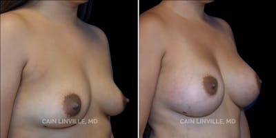 Breast Augmentation Before & After Gallery - Patient 8522864 - Image 4