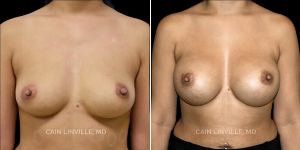 Breast Augmentation Before & After Gallery - Patient 8522879 - Image 1
