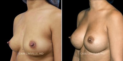Breast Augmentation Before & After Gallery - Patient 8522879 - Image 2