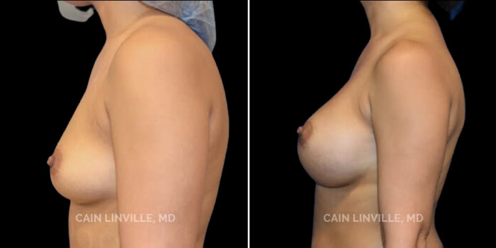 Breast Augmentation Before & After Gallery - Patient 8522879 - Image 3