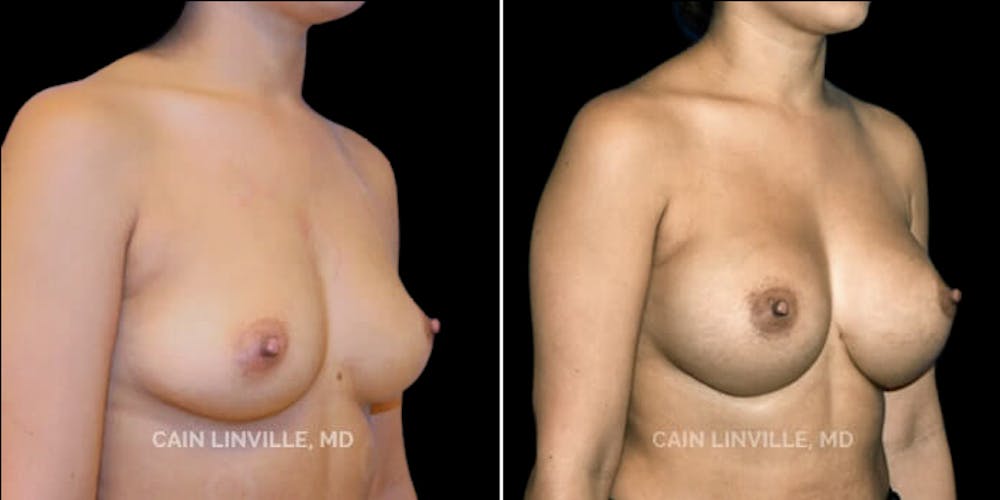 Breast Augmentation Before & After Gallery - Patient 8522879 - Image 4