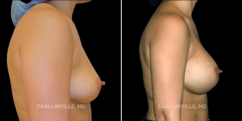 Breast Augmentation Before & After Gallery - Patient 8522879 - Image 5