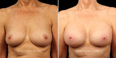 Breast Augmentation Before & After Gallery - Patient 8522899 - Image 1