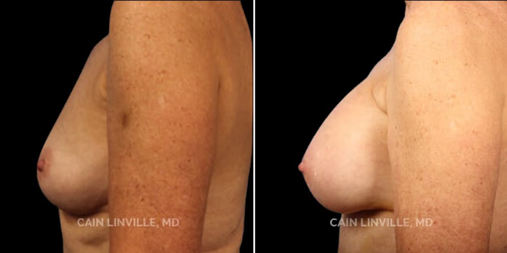 Breast Augmentation Before & After Gallery - Patient 8522899 - Image 3