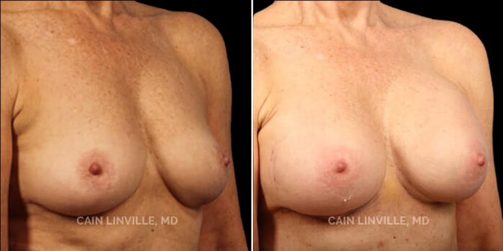 Breast Augmentation Before & After Gallery - Patient 8522899 - Image 4