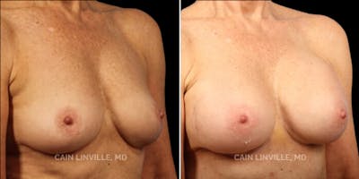 Breast Augmentation Before & After Gallery - Patient 8522899 - Image 4