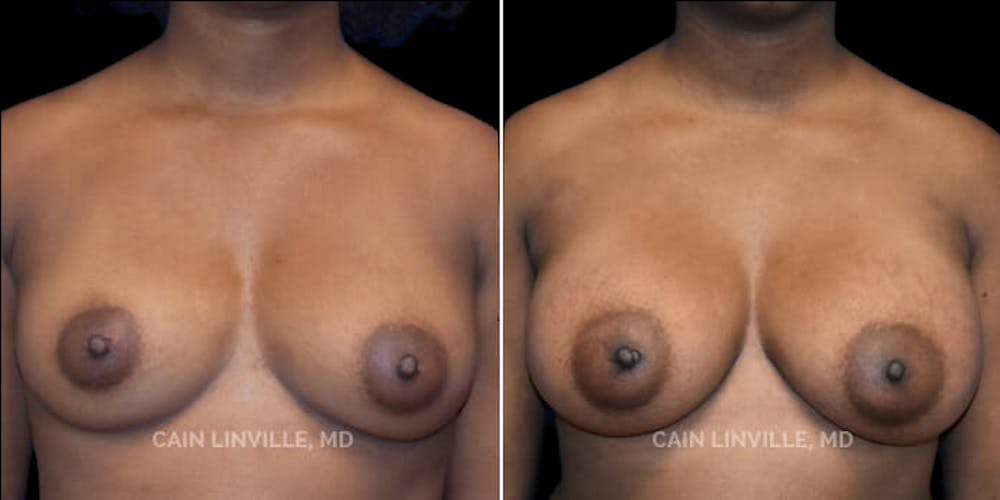 Breast Augmentation Before & After Gallery - Patient 8522912 - Image 1