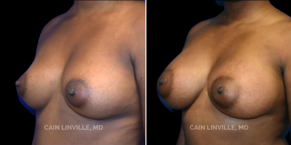 Breast Augmentation Before & After Gallery - Patient 8522912 - Image 2