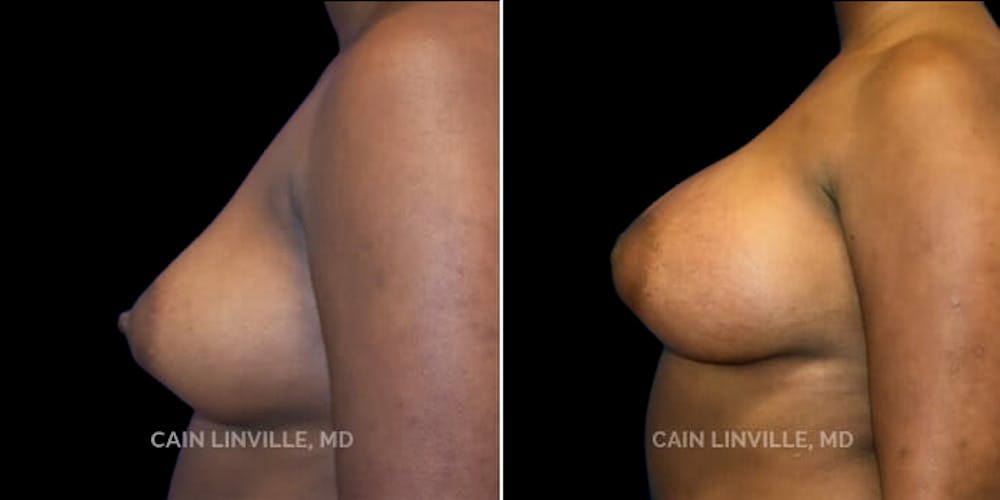 Breast Augmentation Before & After Gallery - Patient 8522912 - Image 3